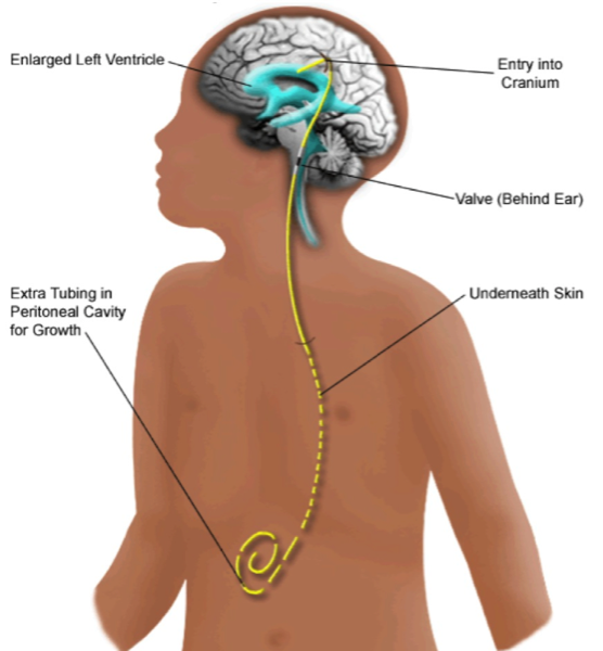 Gavin Davis Neurosurgery Hydrocephalus
